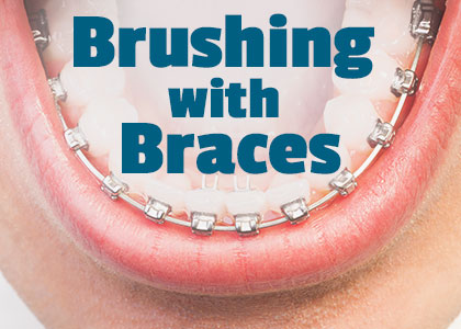 Calgary dentists, Dr. Clark Crawford and Dr. Nikla Reddy of Calgary Dental House inform patients about the best tools and tricks to use when performing oral hygiene routines with braces.
