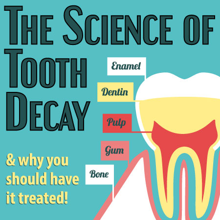 Calgary dentists, Dr. Crawford & Dr. Reddy of Calgary Dental House, discuss the science of tooth decay: what it is and what you can do to prevent it.