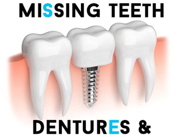 Replace Missing Teeth – Dentures & Dental Implants (featured image)