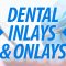 Dental Inlays & Onlays (featured image)