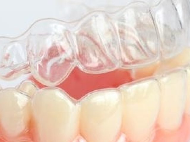 3 Benefits of Spark Clear Aligners (featured image)