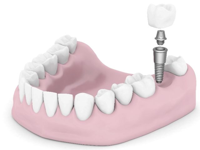 Missing Teeth Hurt Your Quality of Life. A Study Says Dental Implants Can Solve That. (featured image)